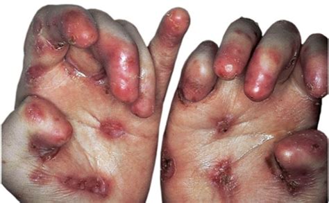 Acd A Z Of Skin Dystrophic Epidermolysis Bullosa