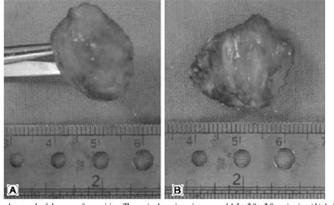 Figure From Tumoral Calcinosis At Lumbar Region A Case Report