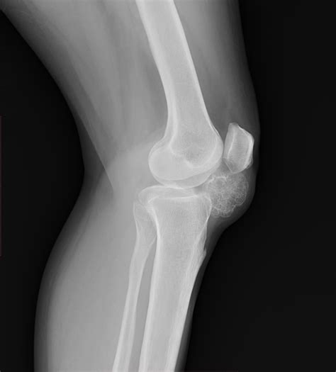 Osteochondroma Extraosseous Image Radiopaedia Org