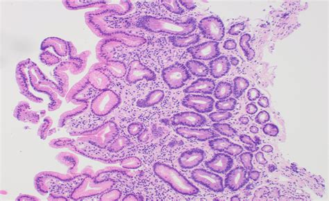 Gastric Antral Mucosa Showing Atrophy Intestinal Metaplasia And Mild Download Scientific