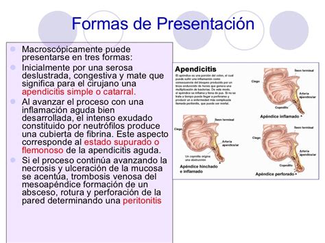 Caso Clinico Apendicitis Aguda Caso Clinico Apendicitis Aguda Mujer