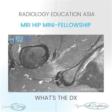 Iliofemoral Ligament Mri