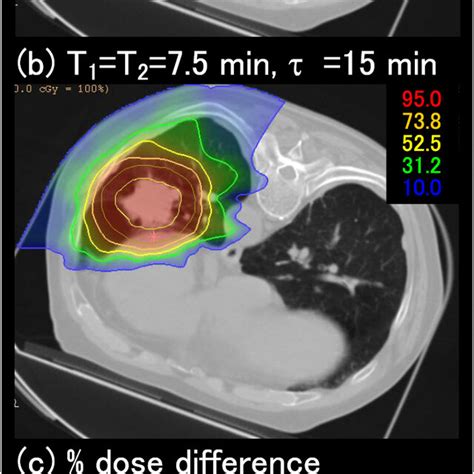 A Planned Clinical Dose Distribution In An Nsclc Case For The