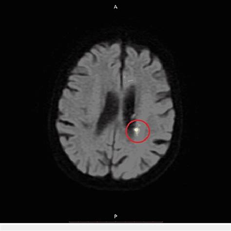 Axial Diffusion Weighted MRI Of The Head Brain WWO IV Contrast