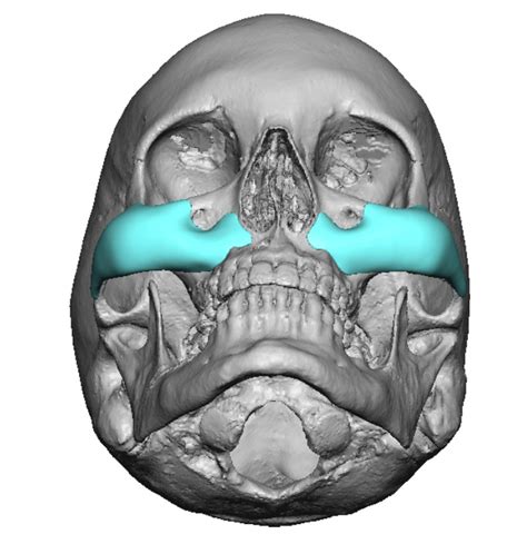 Plastic Surgery Case Study Increasing Midface Projection And Lift