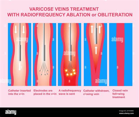 Venas Varicosas Tratamiento Con Ablaci N Por Radiofrecuencia