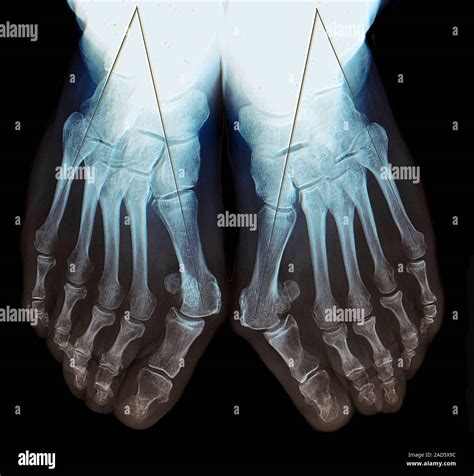 Bunion Assessment Coloured X Rays Showing A Year Old Woman S Feet