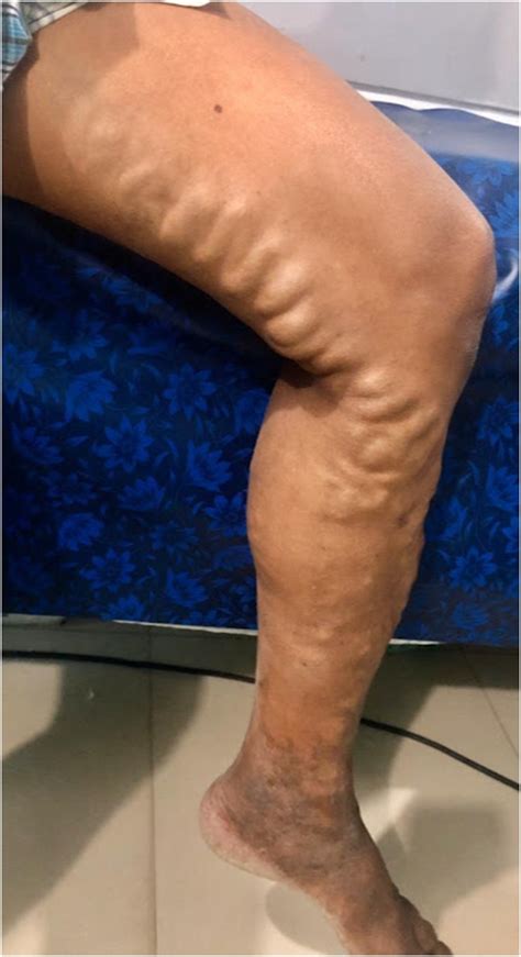 Why Varicose Veins Should Be Treated By Vascular Surgeons