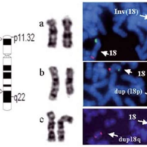 The Partial Array Cgh Revealing The 18p Deletion And The 18q Download Scientific Diagram