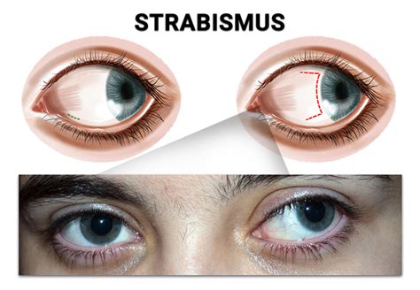 Understanding Strabismus in Adults: Causes, Diagnosis & Treatment