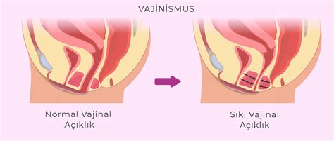 Vajinismus Nedir Belirtiler Ve Tedavi Y Ntemleri Op Dr G N L Imen