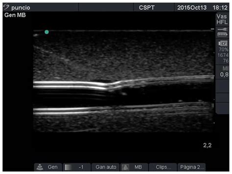 Ultrasound Guided Cannulation Of Dialysis Access Ruben Iglesias