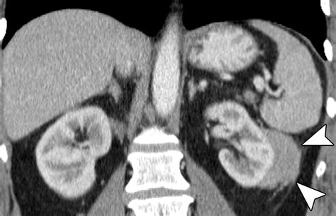 Abdominal Manifestations Of Extranodal Lymphoma Spectrum Of Imaging Findings Ajr