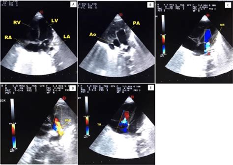 Echocardiography Transthoracic Echocardiogram Of The Patient Showing