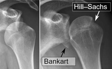 Shoulder Fracture Treatment | Shoulder Bone Fracture Surgery