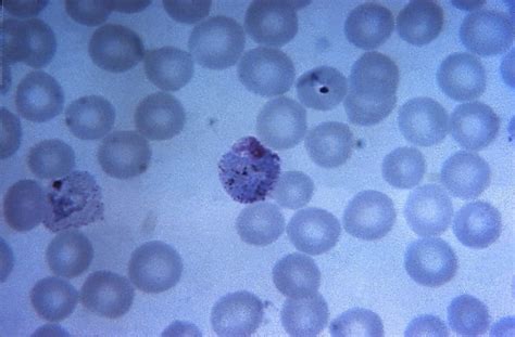 Imagen Gratis Micrografía Delgada Película Madura Plasmodium Vivax Trophozoite Centro