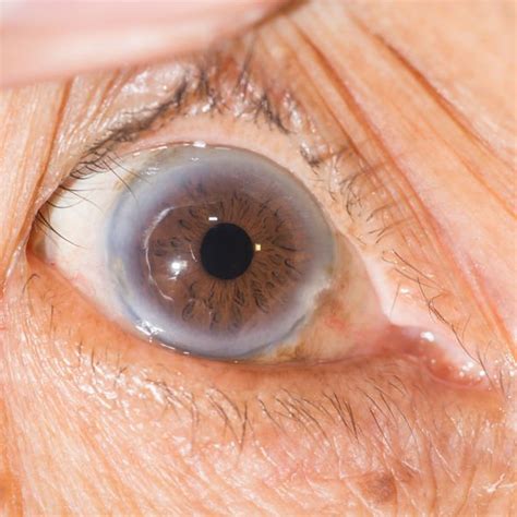 High cholesterol: A grey or white half circle in the eyes could be arcus senilis and is a ...