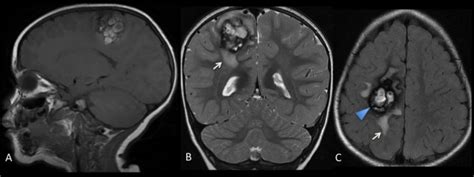 Cavernous Malformation Cm Classic Morphology A T1w Mr Imaging