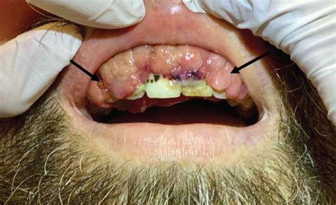 Gingival Overgrowth In Acute Monocytic Leukemia Cleveland Clinic