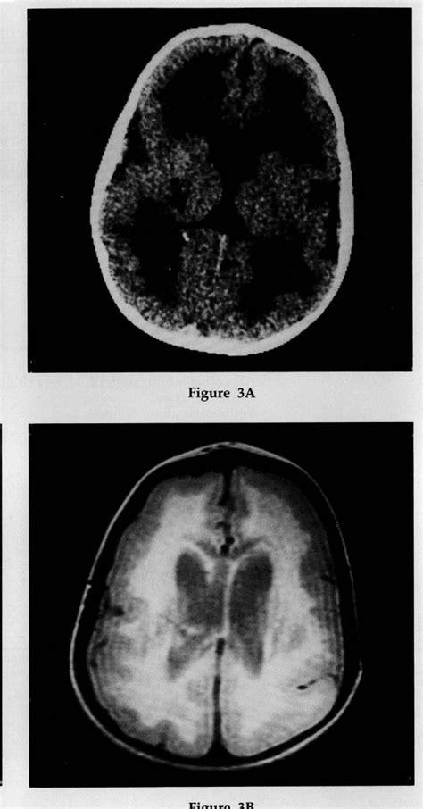 Cobblestone Lissencephaly | Semantic Scholar