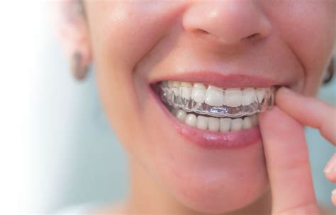 Retainers Specialist Orthodontist In Dublin Dundrum Orthodontics