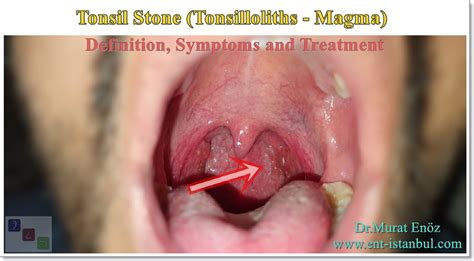 Tonsils Stones