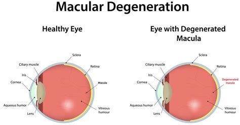 Macular Degeneration Yeager Vision Care Greenville South Carolina