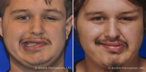 Smile Reanimation Photos Pasadena Ca Patient 8534