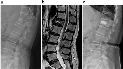 Figure And Table Surgical Treatment Of Vertebral Compression Fracture