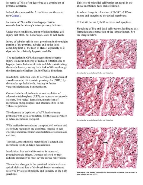 Acute Tubular Necrosis Usmle