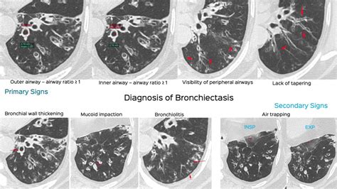 Case 47: When Does RB become RBILD and RBILD-Fibrosis?