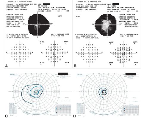 Visual field defect - American Academy of Ophthalmology