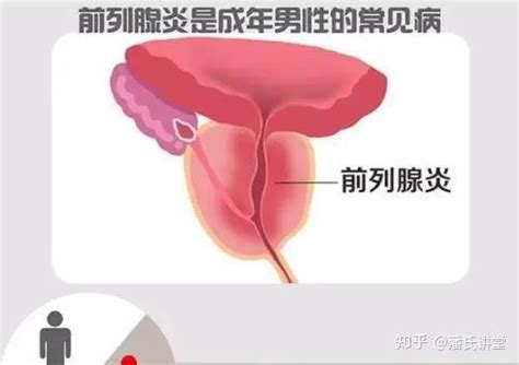 查出前列腺炎如何正确应对？ 知乎