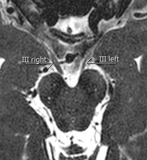 E Transverse 3d T2w Mr Image With Thickened Cisternal Segment Of Right