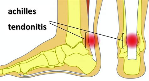 Plantar Fasciitis Our Complete Guide Cornerstone Physiotherapy