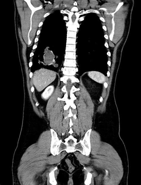 Lung Sequestration Image Radiopaedia Org