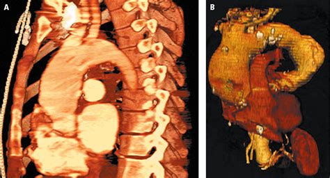 Thoracic Aortic Aneurysm 3d