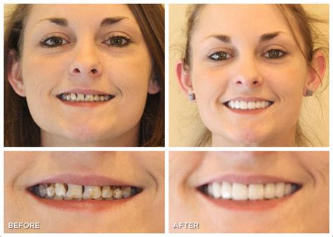 Before And After Photos Thornton Dental Care