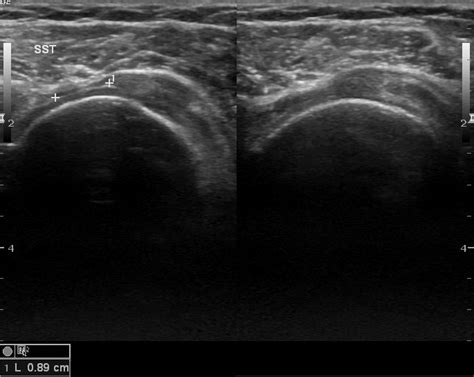 Supraspinatus tear | Image | Radiopaedia.org