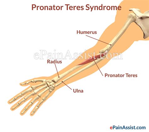 Gallery For > Pronator Teres Syndrome Pain