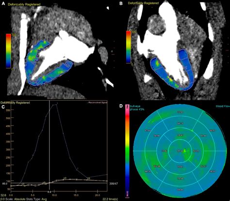 Frontiers Dose Reduction Of Dynamic Computed Tomography Myocardial