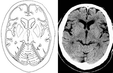 MBBS Medicine (Humanity First): CT SCAN OF HEAD