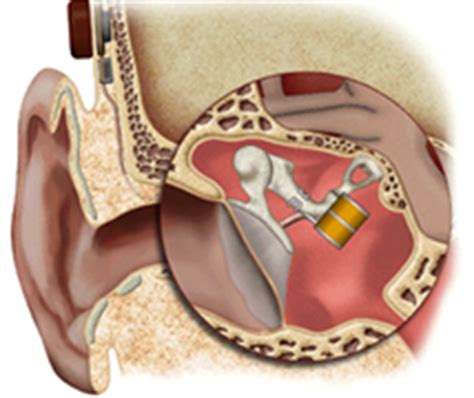 Middle Ear Implants - Gardner Audiology