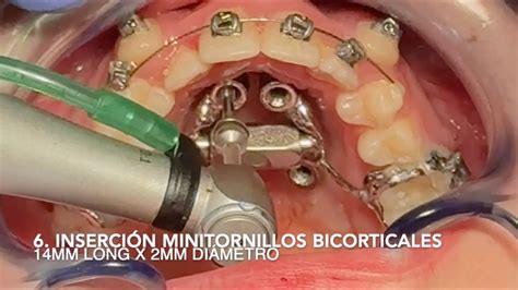 Secuencia Colocación MARPE Expansión Maxilar Rápida Osteosoportada