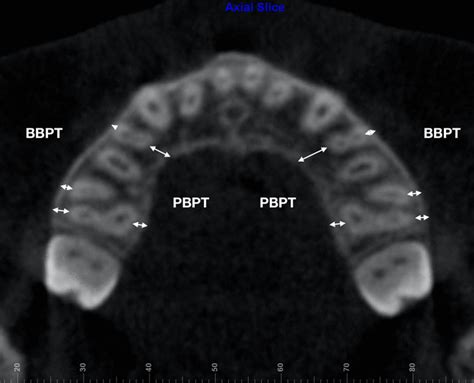 CBCT Image Illustrating Periodontal Variables BBPT Buccal Bone Plate