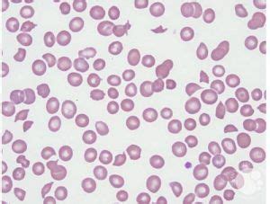 Blood Morphology Ask Hematologist Understand Hematology