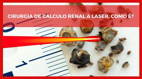 Cirurgia De C Lculo Renal A Laser Como Youtube