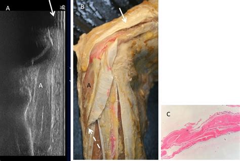 A An Ultrasound View B Anatomical Dissection Of The Anconeus Muscle