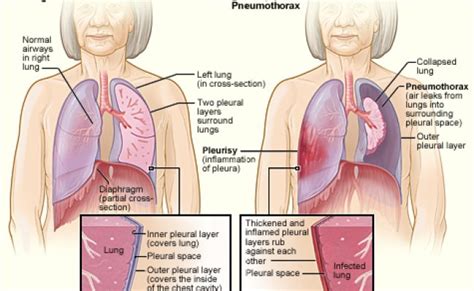 Difference Between Pneumonia And Pleurisy Definition Cause Risk Factors