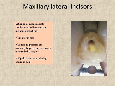 Access Cavity Preparation Contents Definition What Is An